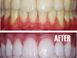 teeth-whitening-victoria-bc